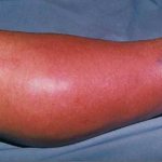 What to use for a wasp sting how to treat a wasp sting for severe allergies