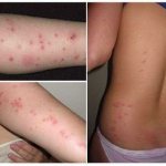 Photos of linen lice bites on the human body and proper treatment
