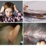 How to quickly get rid of nits and lice at home