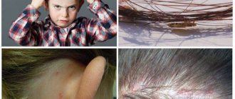How to quickly get rid of nits and lice at home