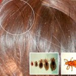 How to get rid of fleas in a person&#39;s hair