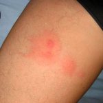 what do flea bites look like on humans