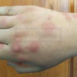 Do bedbugs bite through clothes - photos of bites