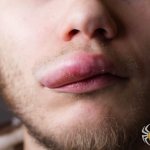Swelling of the lip after a wasp sting