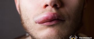 Swelling of the lip after a wasp sting