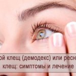 Ресничный клещ или глазной клещ (демодекс): симптомы и лечение