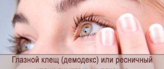 Eyelash mite or eye mite (Demodex): symptoms and treatment